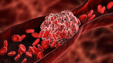 Đánh giá về việc sử dụng hạt nano để điều trị huyết khối do nhiễm SARS-CoV-2