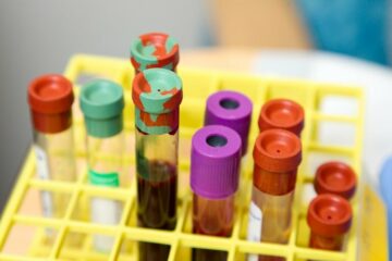 Sysmex की अल्ज़ाइमर रोग परीक्षण किट को जापान में विपणन स्वीकृति प्राप्त है