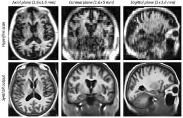 AI menciptakan gambar otak beresolusi tinggi dari pemindaian MR berkekuatan medan rendah