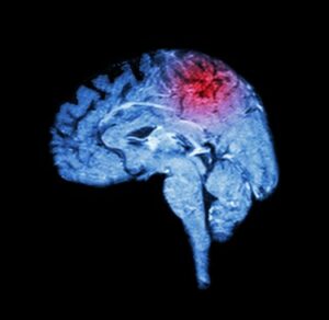Cannabisolje for hjerneslagpasienter - hva de siste medisinske studiene forteller leger