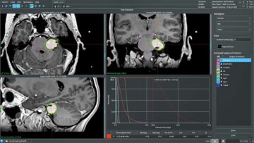 Exploring Leksell Gamma Knife® workflows with game-changing planning tools