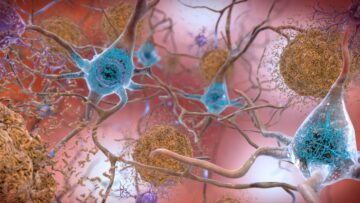 GPT-3’s Next Mark: Diagnosing Alzheimer’s Through Speech