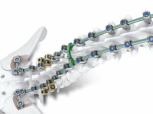 Orthofix Medical launches Mariner screw system
