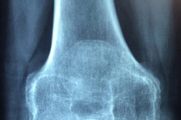 Lea las últimas nanonoticias de Genesis Nanotech en línea: artículos como: Un nuevo compuesto oral descubierto e investigado por el general de Massachusetts puede ayudar a prevenir y tratar la osteoporosis
