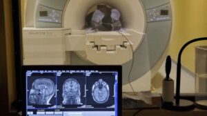 Διέγερση του εγκεφάλου στα 40 Hz για τη θεραπεία της νόσου του Αλτσχάιμερ