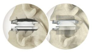 Centinel Spine® tillkännager den 500:e proceduren med prodisc® C Vivo och prodisc C SK Cervical Total Disc Replacement System