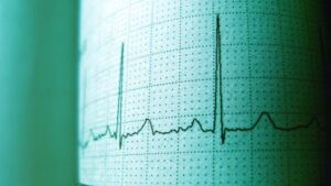 Concurrerende pacemakers creëren onderscheidende drielingen in hartslagen