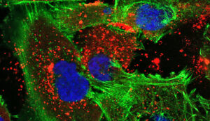 Taistelu aivosyöpää vastaan ​​bioadhesiivisten nanohiukkasten avulla