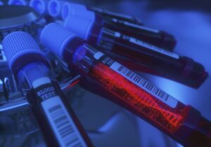 Новый тест на основе нанотехнологий может обнаруживать и профилировать рак простаты даже в микроскопических количествах