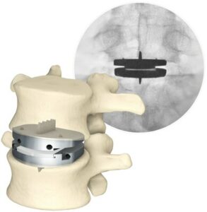 Aetna® 更新光盘更换指南； 所有主要付款人现在都承保 Centinel Spine 的腰椎全椎间盘置换术