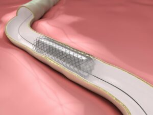 Olympus joins biliary stent sector – market predicted to be $1bn by 2030