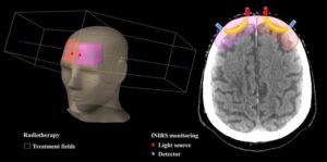 मस्तिष्क के ऊतकों के ऑक्सीकरण की वास्तविक समय की निगरानी रेडियोथेरेपी को वैयक्तिकृत कर सकती है