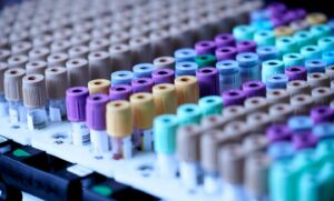 रोवन-वर्चुआ एसओएम और ड्यूरिन अल्जाइमर के रक्त परीक्षण डेटा की रिपोर्ट करते हैं