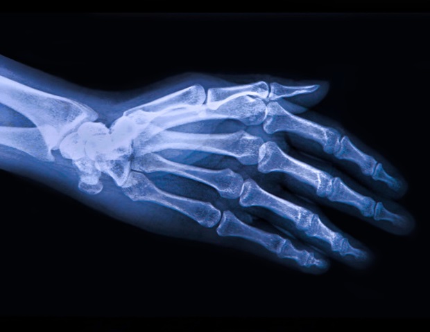 Une nouvelle thérapie cellulaire injectable est prometteuse pour le traitement de l'arthrose
