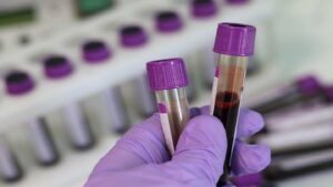 FDA ایمونواسی های ترمو فیشر را برای ارزیابی خطر پره اکلامپسی تایید می کند