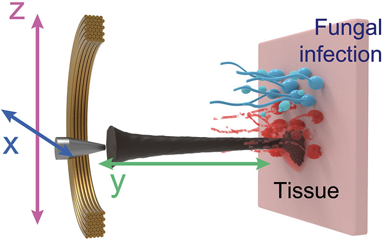 Электромагнитные ядра точно направляют массив нанозим-ботов, нацеленных на место грибковой инфекции.
