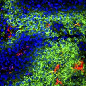 纳米技术增强了攻击肿瘤的T细胞的有效性