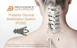 Providence Medical Technology kunngjør fullført registrering i den kliniske FUSE-studien for pasienter med høyrisiko-cervical fusjon