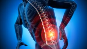 ההליך של Relievant מספק הקלה ארוכת טווח בכאבי גב כרוניים