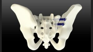 SurGenTec obtient l'approbation de la FDA pour le système de fusion de l'articulation sacro-iliaque TiLink-L