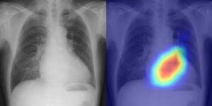 深度学习模型利用胸部 X 光检查心脏病 - 物理世界