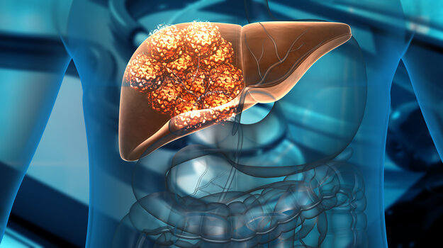 Pictured: Cancer cells growing on the liver/iStock, Rasi Bhadramani