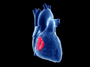First two patients treated in US trial for Trisol’s tricuspid valve