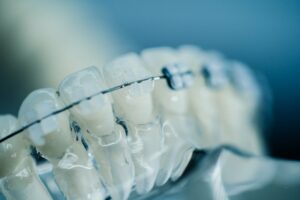 LightForce Ortodonti samler inn 80 millioner dollar for 3D-printede personlige tannreguleringer