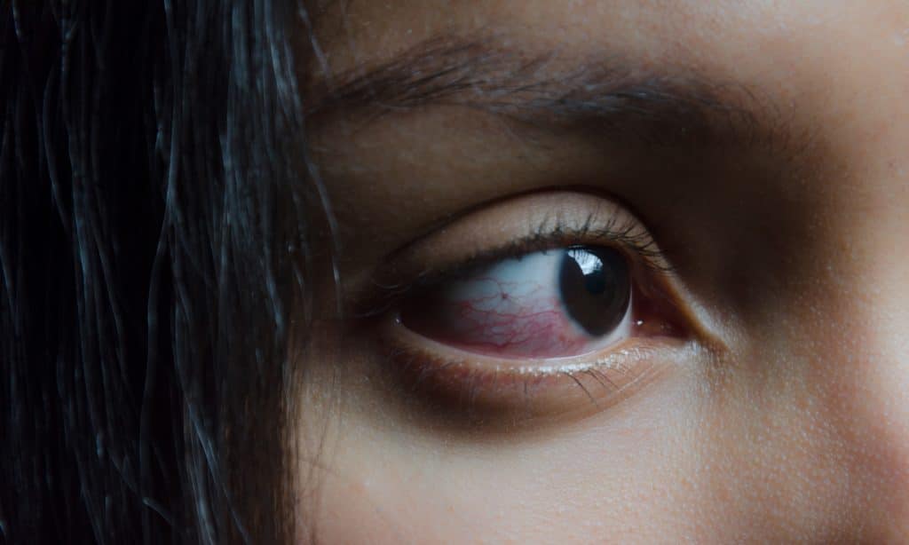 Why Does Smoking Weed Make Your Eyes Red?