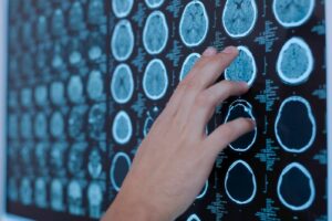 Arrojando luz sobre el Día de Concientización sobre el Cáncer Cerebral y la Semana de Concientización sobre los Tumores Cerebrales en Canadá