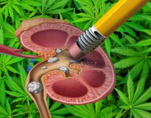Tem Pedras? - A cannabis pode reduzir o risco de pedras nos rins em homens, afirma novo estudo médico