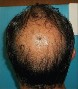 Izvleček konoplje je obrnil izpadanje las v novi študiji alopecije