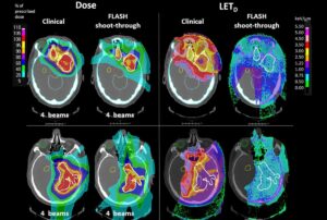 FLASH پروتون شلیک شده: رویکردی قوی برای درمان تومور مغزی - دنیای فیزیک
