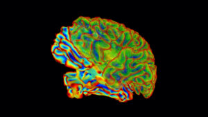 Aivoimplantti parantaa huomattavaa toipumista potilailla, joilla on vakava aivovamma