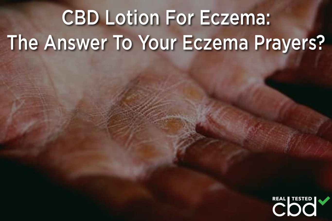 CBD Lotion For Eczema: The Answer To Your Eczema Prayers? - Medical Marijuana Program Connection