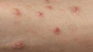 Studien finner att enhet för upptäckt av hudcancer ökar frekvensen av remisser från kliniker