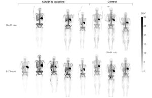 Total-body PET-billeddannelse afslører immunrespons hos COVID-19-patienter - Physics World