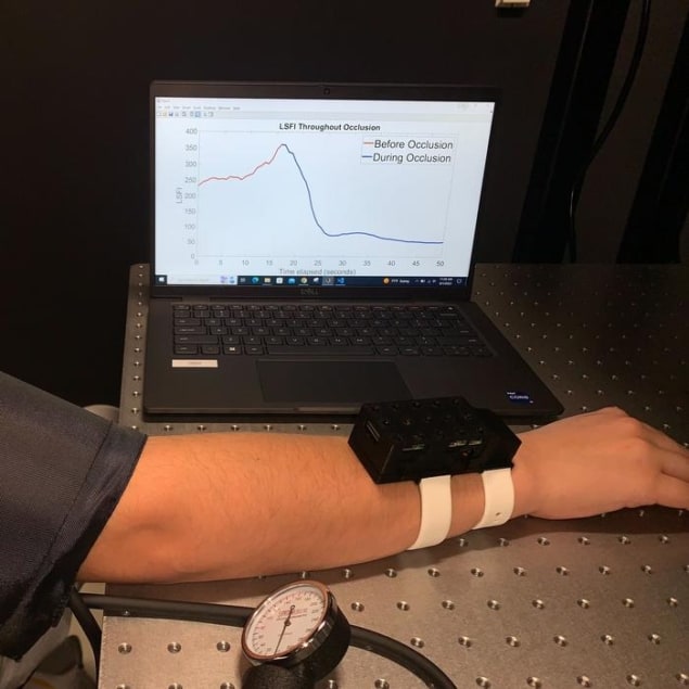 एक नए पहनने योग्य इमेजिंग उपकरण का फोटो जो रोगी के हाथों, पैरों या बाहों में रक्त प्रवाह में परिवर्तन पर नज़र रखता है। यह उपकरण एक व्यक्ति की कलाई पर बंधा हुआ है और व्यक्ति लैपटॉप स्क्रीन पर ग्राफ देख रहा है