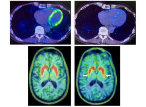 Südame PET-skaneeringud võivad ennustada neurodegeneratiivsete haiguste teket riskirühma kuuluvatel inimestel - Physics World