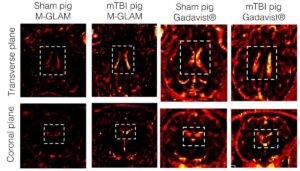Miếng dán siêu nhỏ bám dính đại thực bào cho phép MRI phát hiện tình trạng viêm não – Vật lý Thế giới