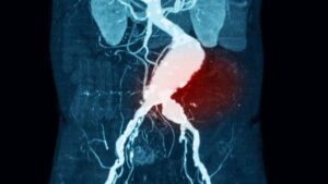 Nectro aloittaa endovaskulaarisen aneurysman stabilointijärjestelmän kliinisen tutkimuksen