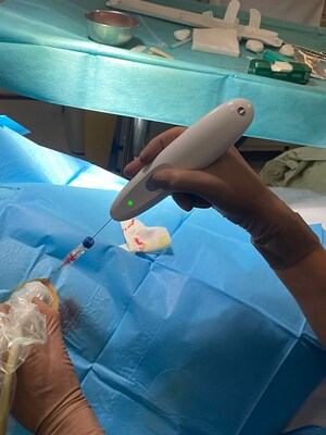 O dispositivo de passagem única cauterizando após um procedimento de biópsia renal